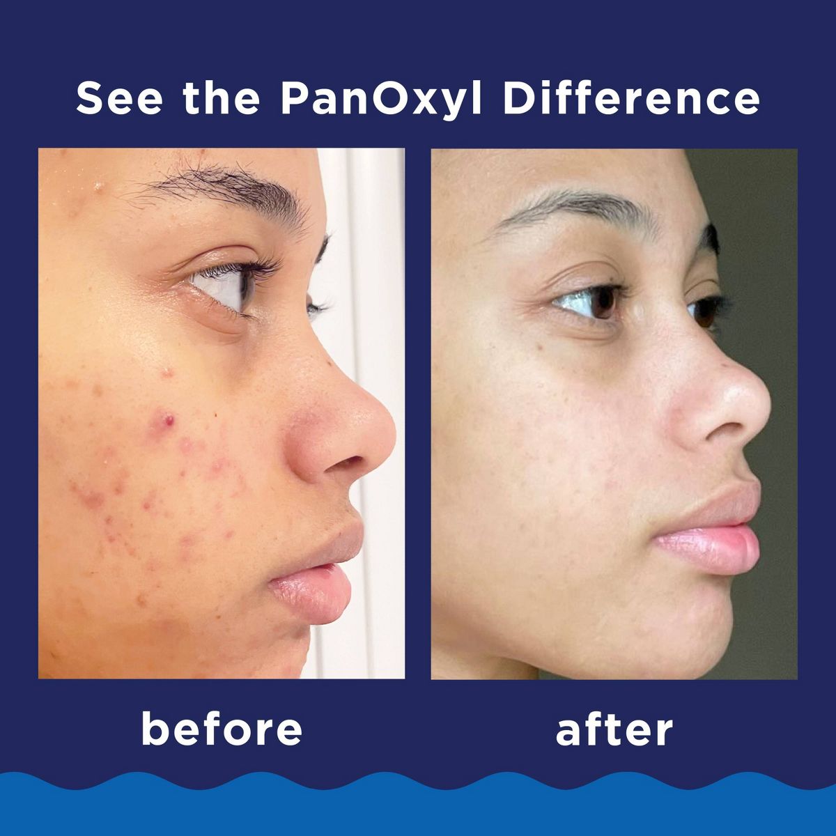 PanOxyl 10% Benzoyl Peroxide Acne Foaming Wash - 5.5oz