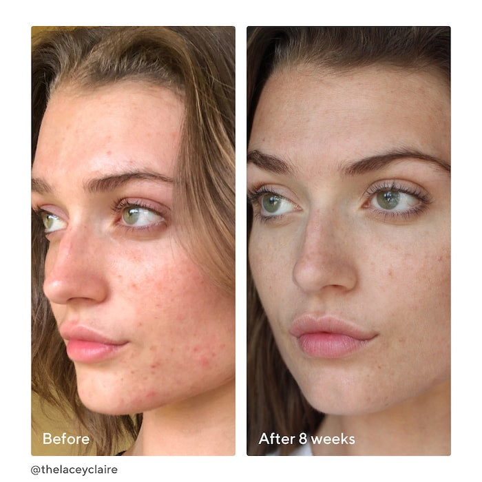 Murad InvisiScar Resurfacing Treatment 0.17oz / 5mL Travel Size