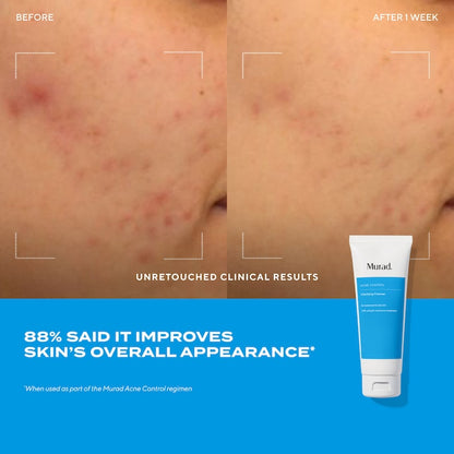 Murad Clarifying Gel Cleanser with Dual Salicylic Acid for Acne-Prone Skin 150