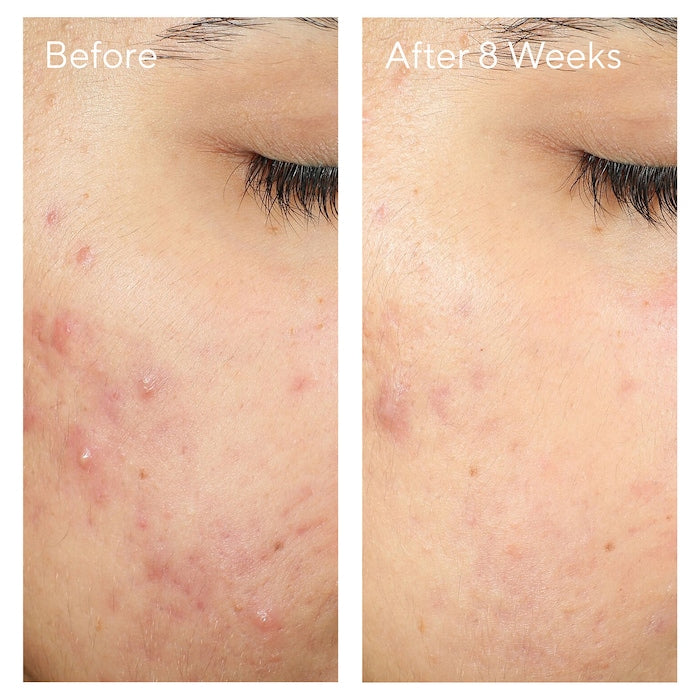 Murad InvisiScar Resurfacing Treatment 0.17oz / 5mL Travel Size
