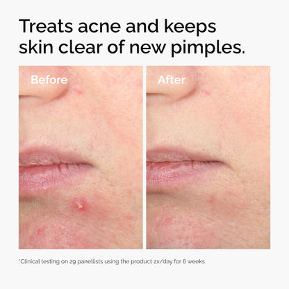 The Ordinary 
Salicylic Acid 2% Solution, Exfoliating Serum for Acne 30ml